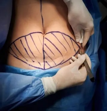 10 Essential Tips for a Successful Abdominoplastia Surgery 1