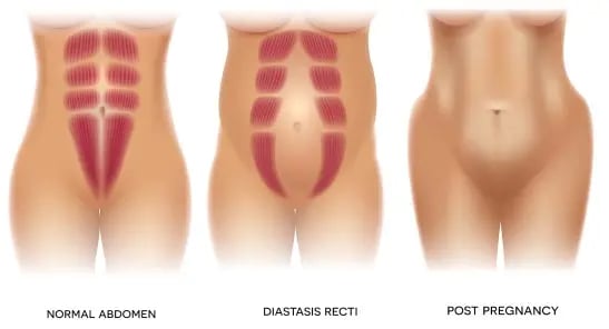 10 Essential Tips for a Successful Abdominoplastia Surgery