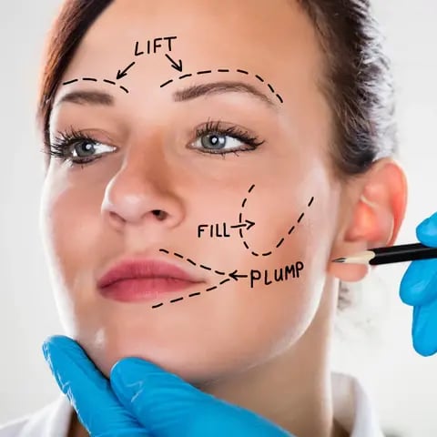 Facial Fat Transfer