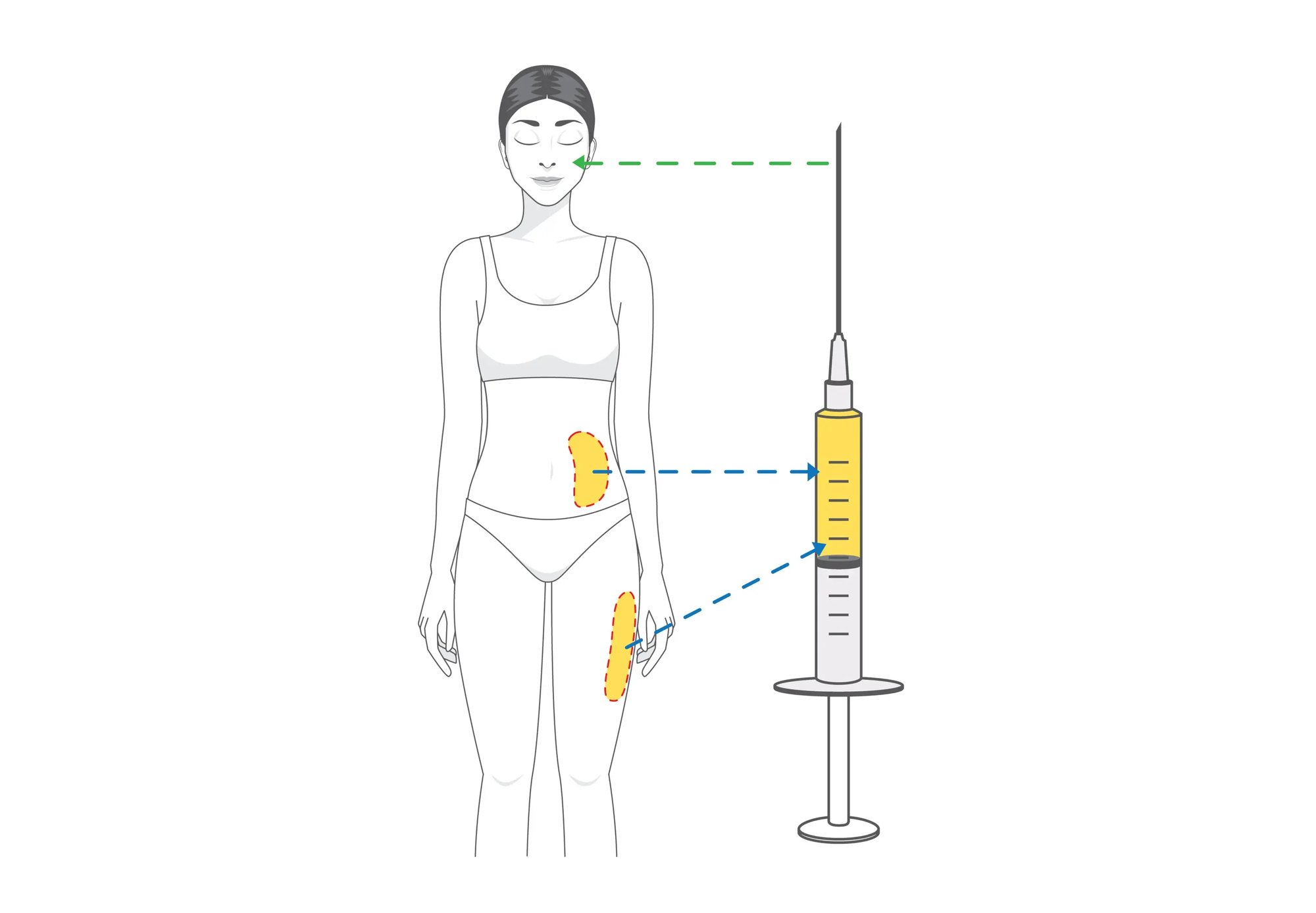 Los Beneficios y Proceso de la Lipotransferencia