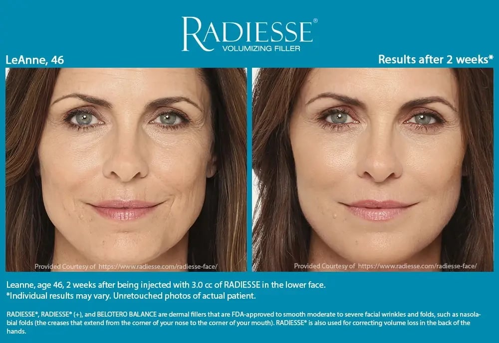 Radiesse Filler