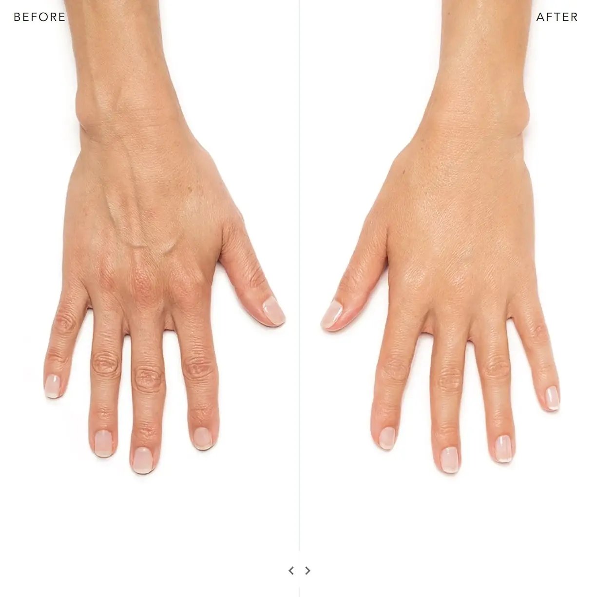 Radiesse Filler2