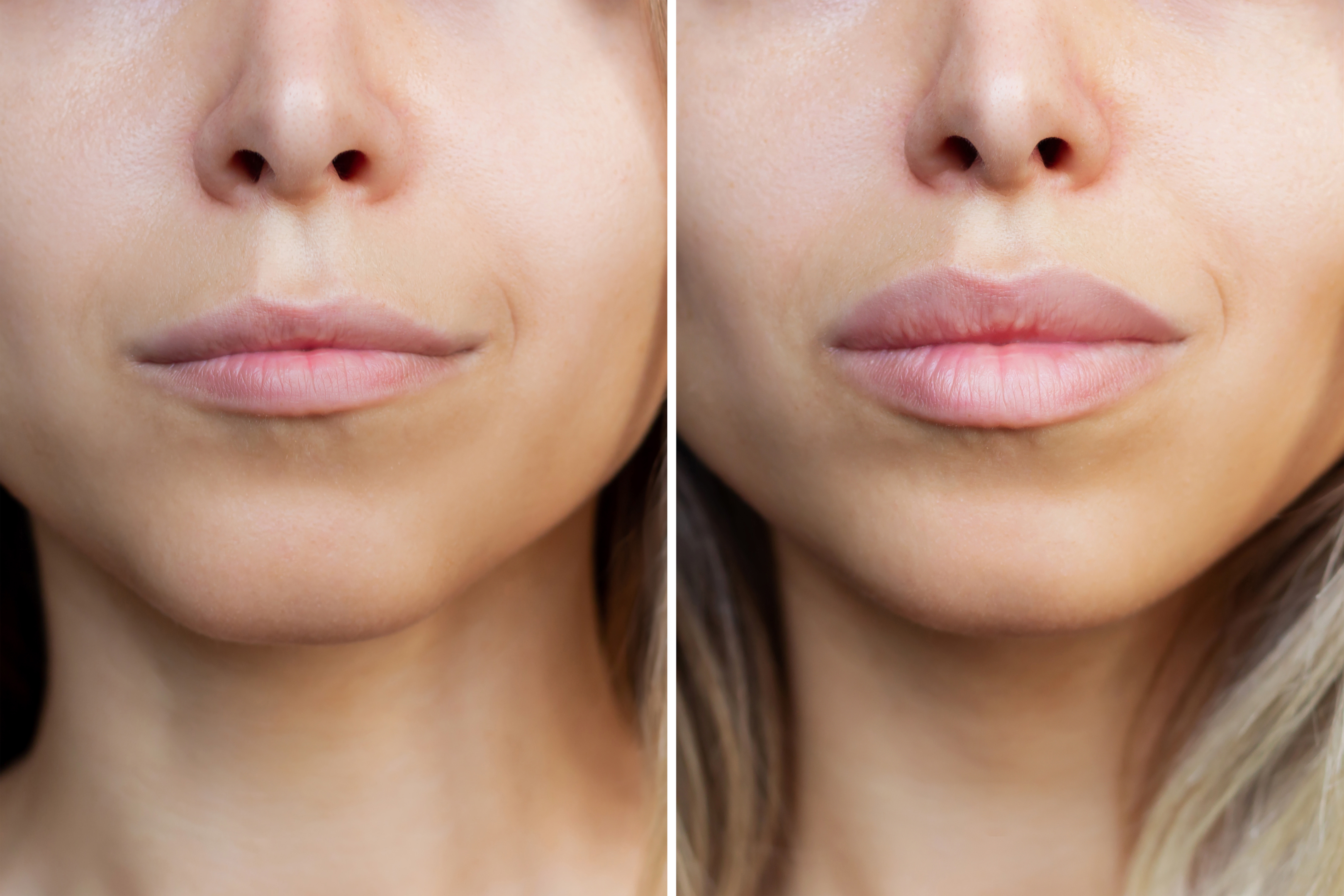 Top 10 Lip Filler Shapes to Enhance Your Natural Beauty3