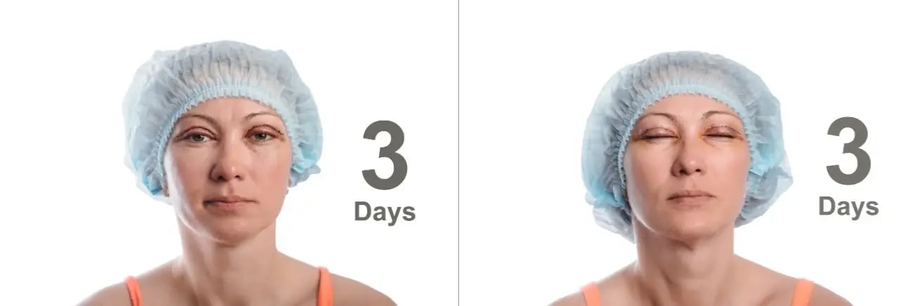 Upper Blepharoplasty Recovery Photos Day by Day 2-imageonline.co-merged