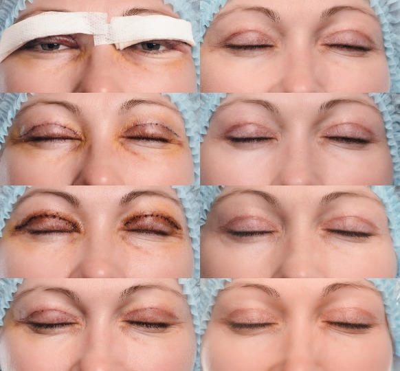 Upper Blepharoplasty Recovery Photos Day by Day